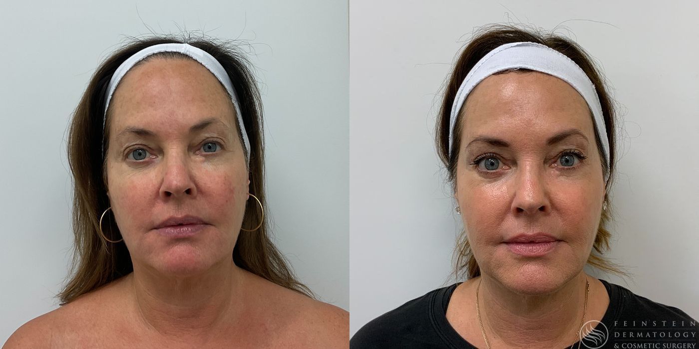 Forever Young® BBL + HALO® Laser - Case 12326