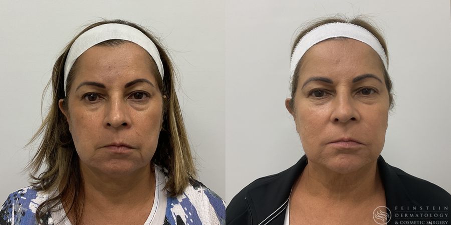 Forever Young® BBL + HALO® Laser - Case 12332