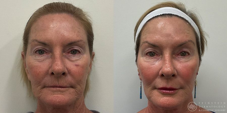 Full Face Rejuvenation - Case 12217