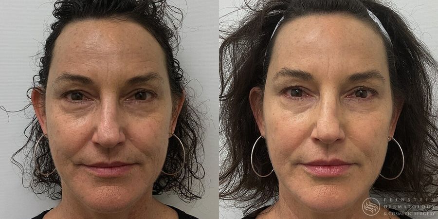 Full Face Rejuvenation - Case 12218