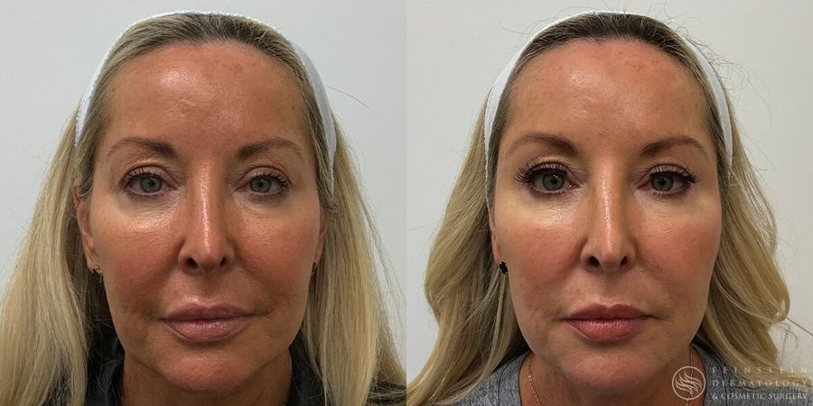 Full Face Rejuvenation - Case 12219