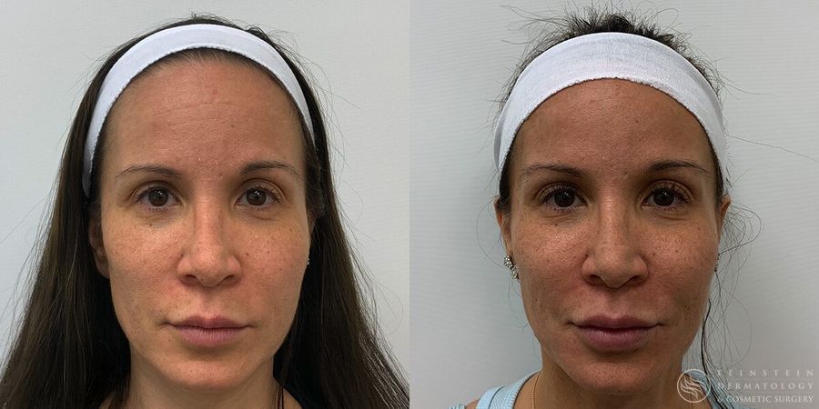 Full Face Rejuvenation - Case 12216