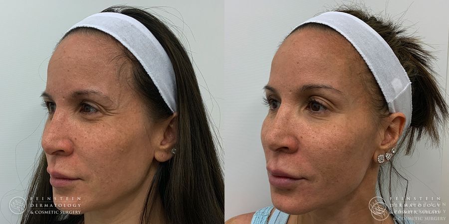 Full Face Rejuvenation - Thumbnail 2