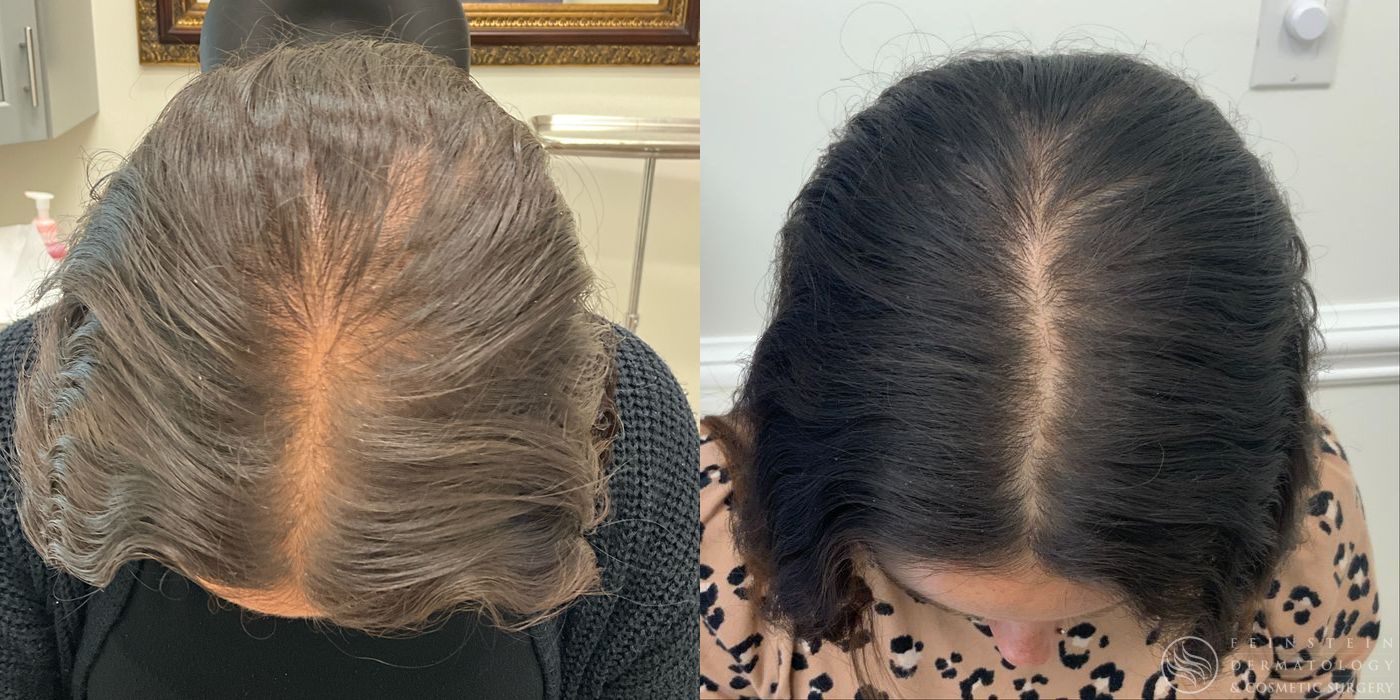 Hair Loss - Case 12220