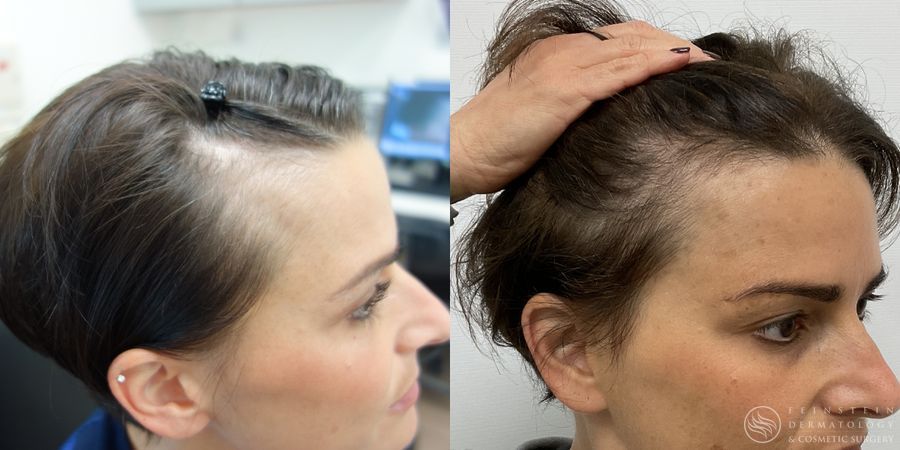 Hair Loss - Case 12221