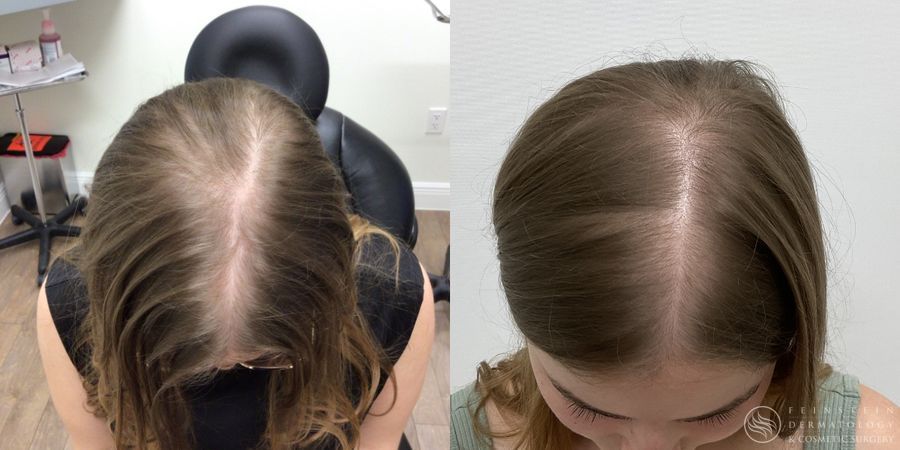 Hair Loss - Case 12222