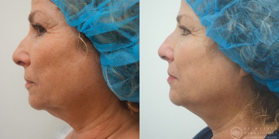 Kybella - Case 12304