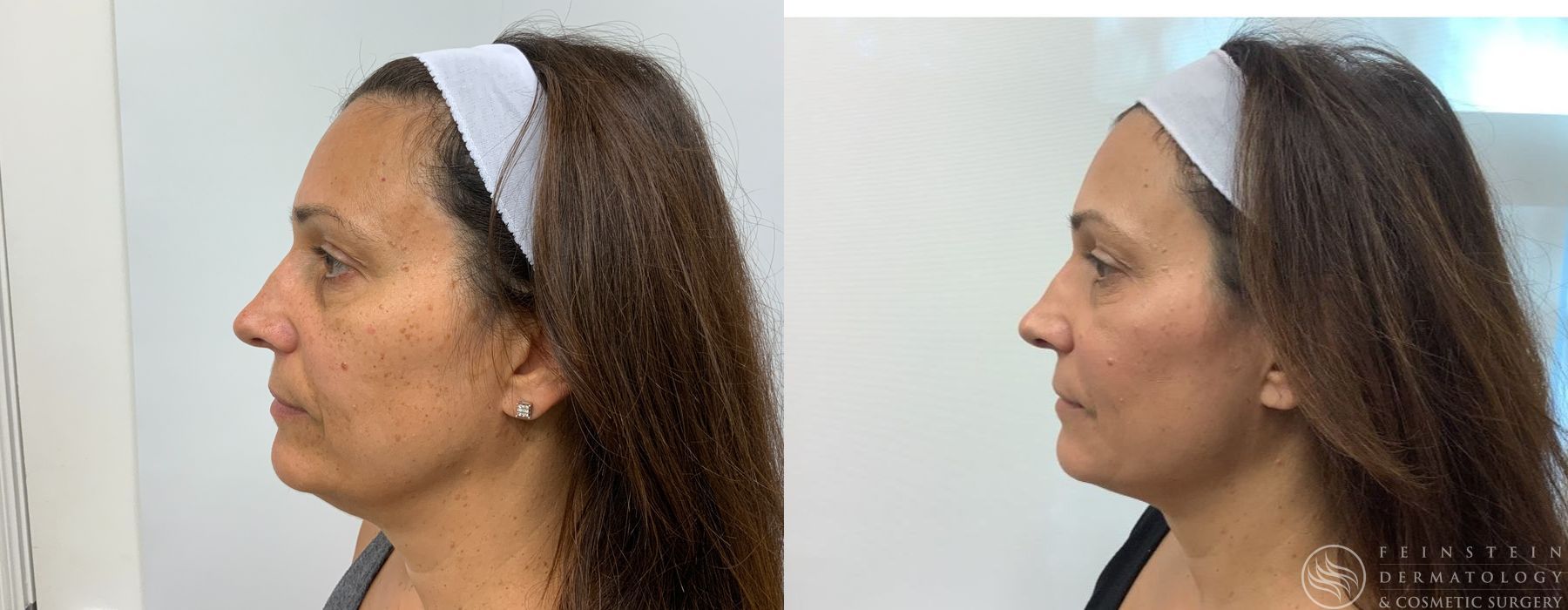 Kybella - Case 12303