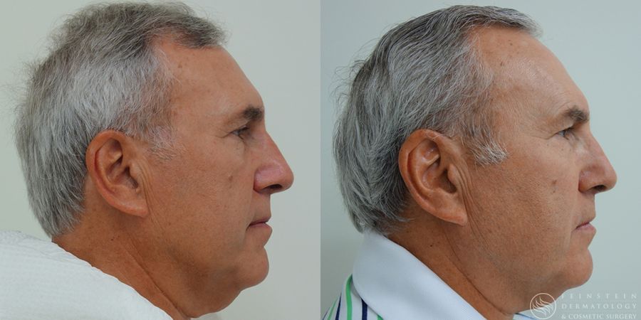 Kybella - Case 12305