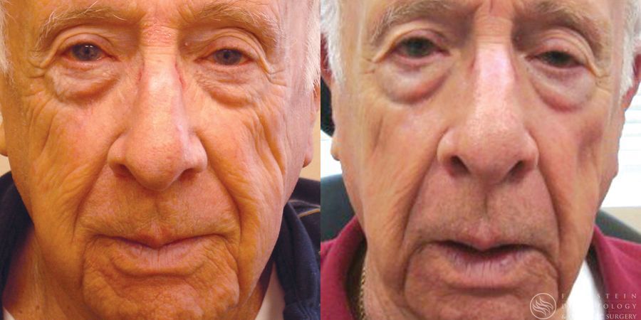 Laser Skin Resurfacing - Case 12337