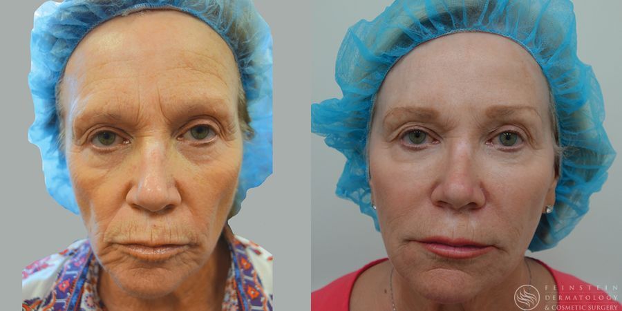 Laser Skin Resurfacing - Case 12339