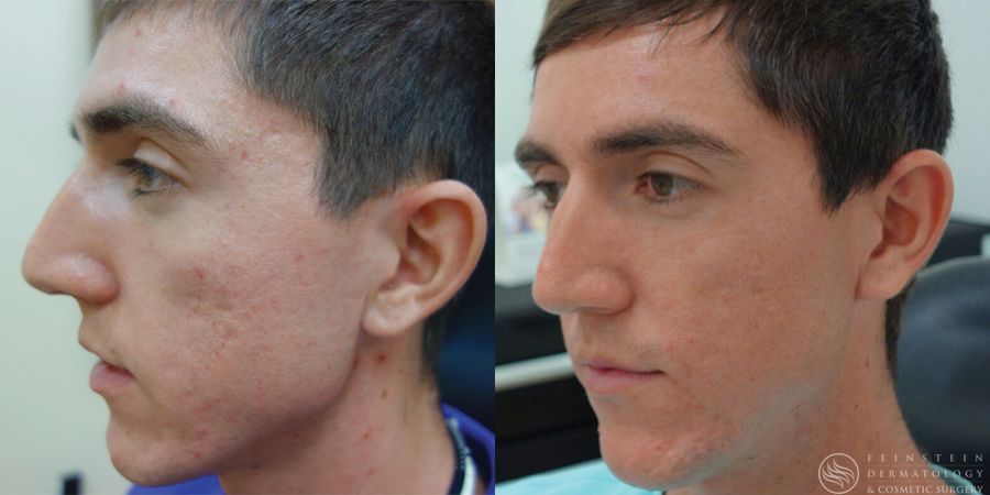 Laser Skin Resurfacing - Case 12338
