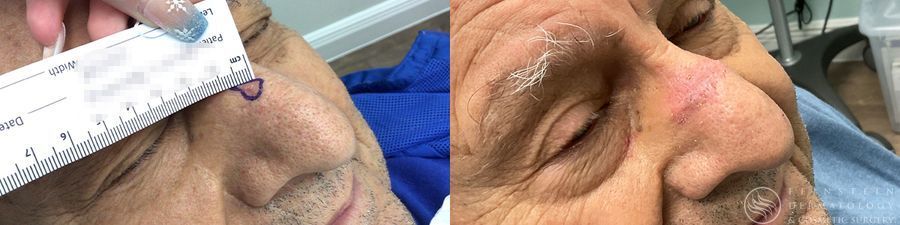 Mohs Surgery - Case 12356