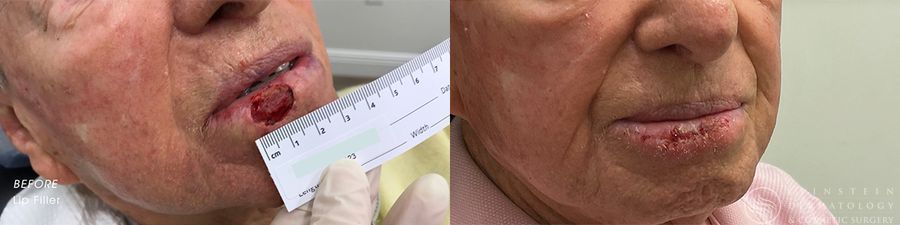 Mohs Surgery - Case 12360