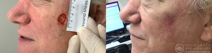 Mohs Surgery - Case 12358