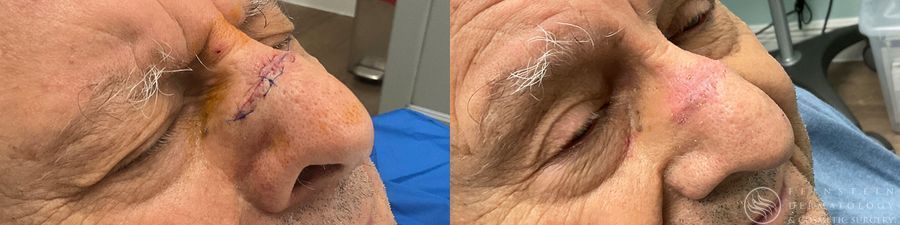 Mohs Surgery - Thumbnail 3