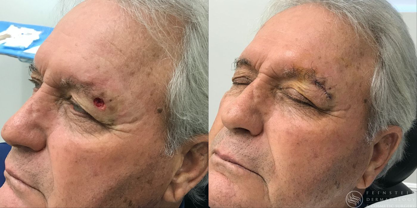 Mohs Surgery - Case 12354