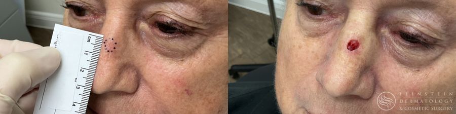 Mohs Surgery - Case 12365