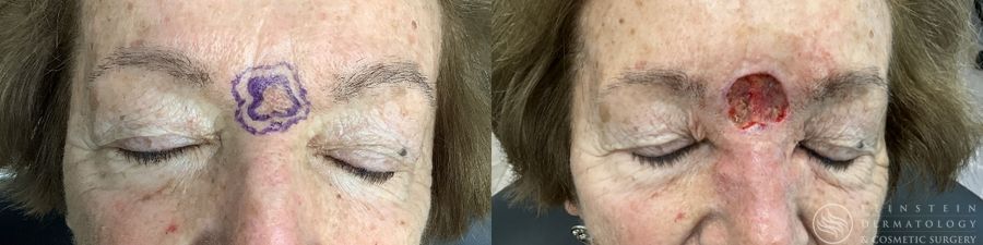 Mohs Surgery - Case 12363