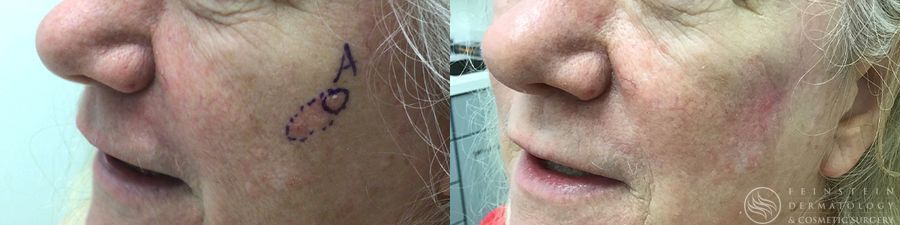 Mohs Surgery - Thumbnail 3