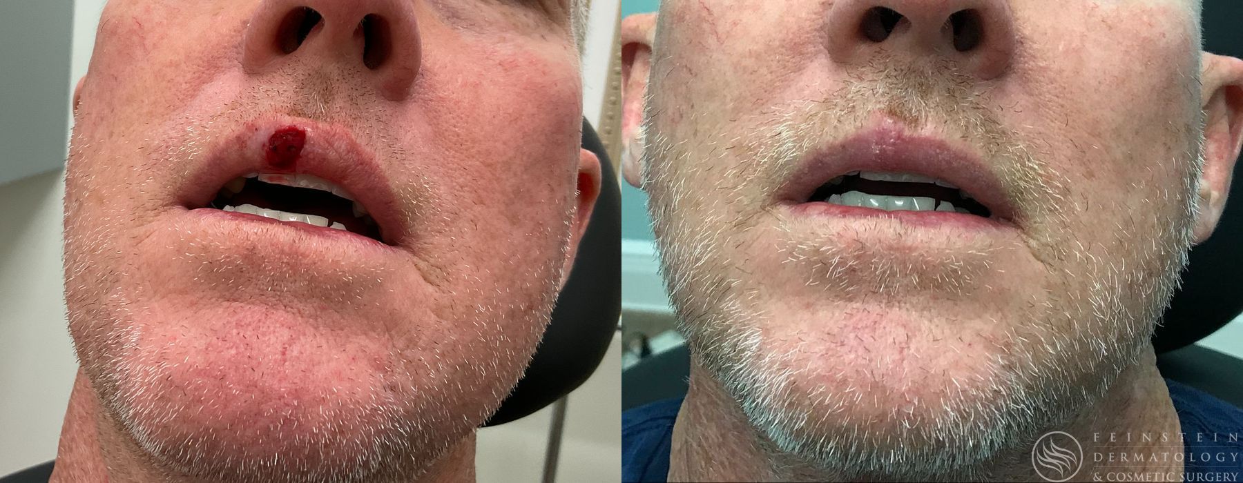 Mohs Surgery - Case 12351