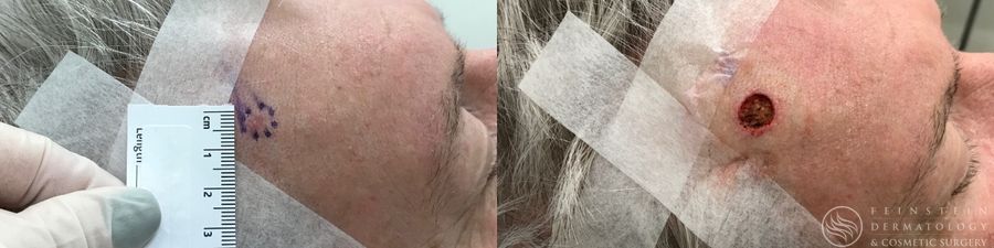 Mohs Surgery - Case 12362