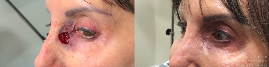 Mohs Surgery - Thumbnail 3