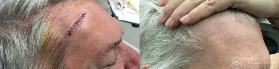 Mohs Surgery - Thumbnail 2