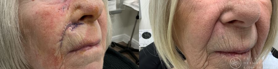 Mohs Surgery - Thumbnail 2