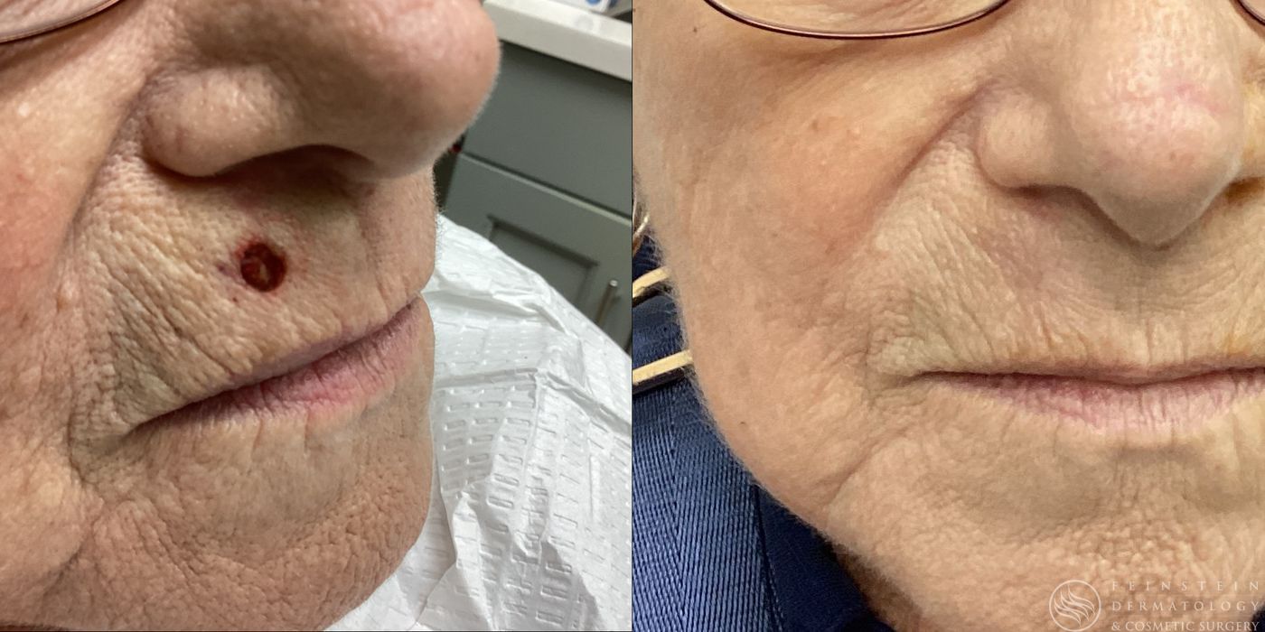 Mohs Surgery - Case 12350