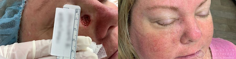 Mohs Surgery - Case 12361