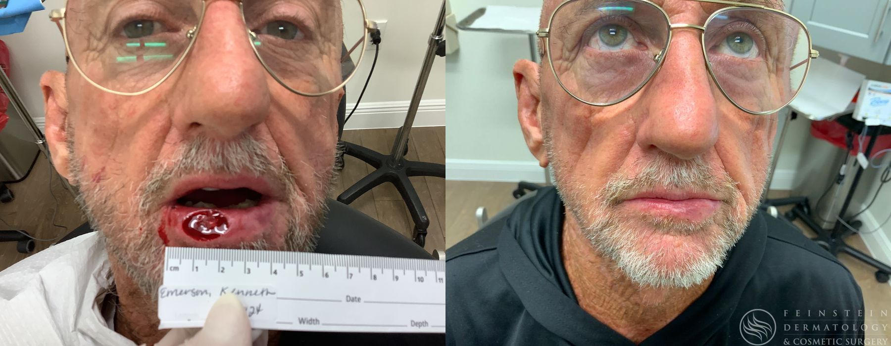 Mohs Surgery - Case 12353