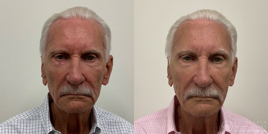 Sculptra - Case 12306