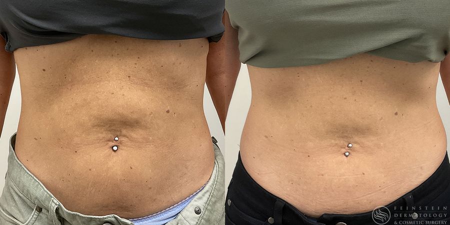 SkinTyte (Face+Body) - Case 12341