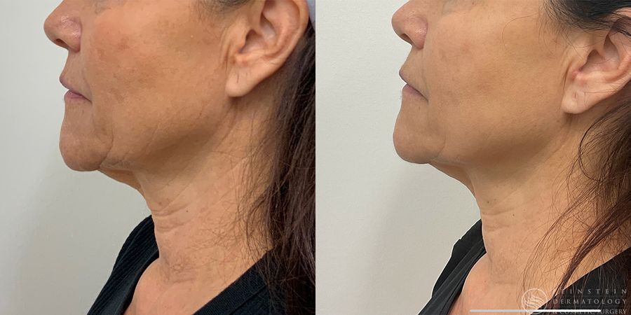 SkinTyte (Face+Body) - Case 12342