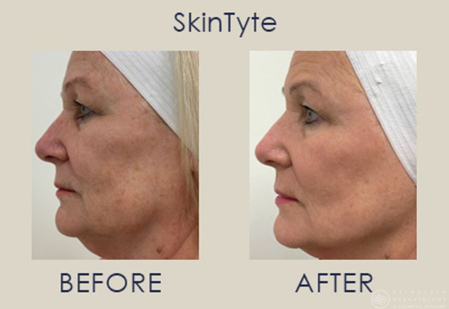 SkinTyte (Face+Body) - Case 12343