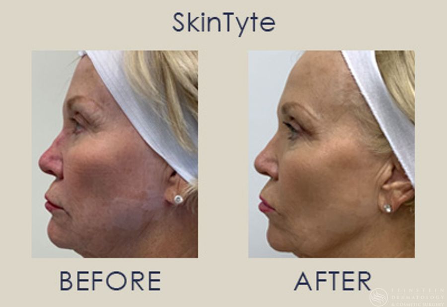 SkinTyte (Face+Body) - Case 12345