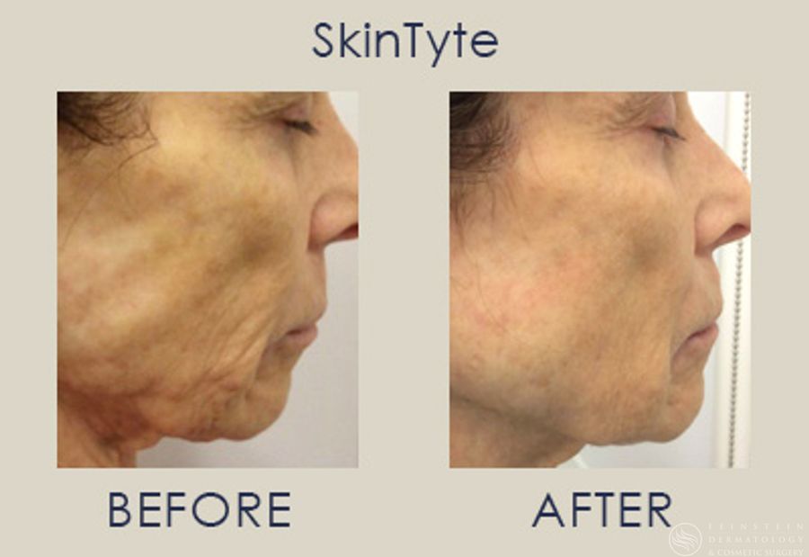 SkinTyte (Face+Body) - Case 12344