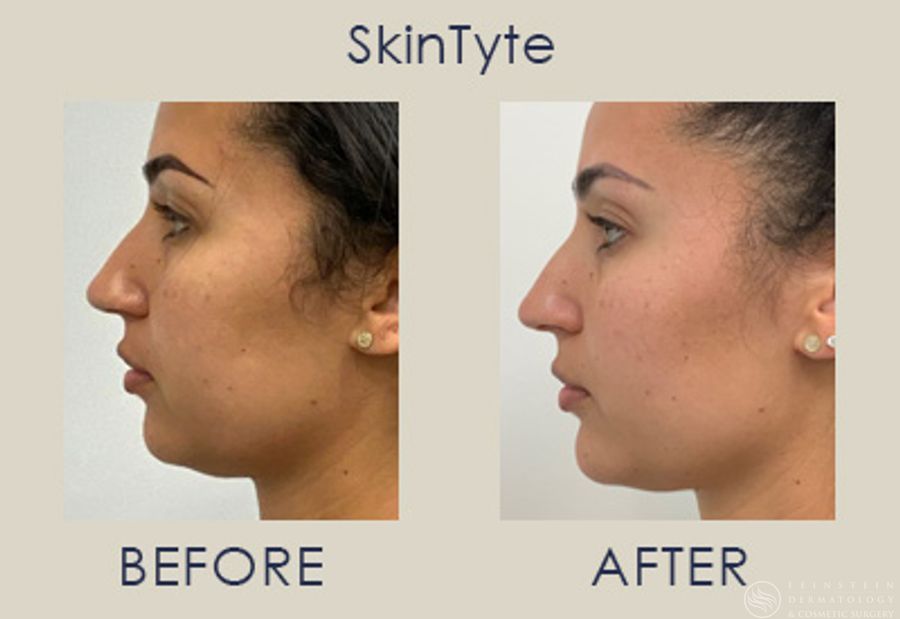 SkinTyte (Face+Body) - Case 12346