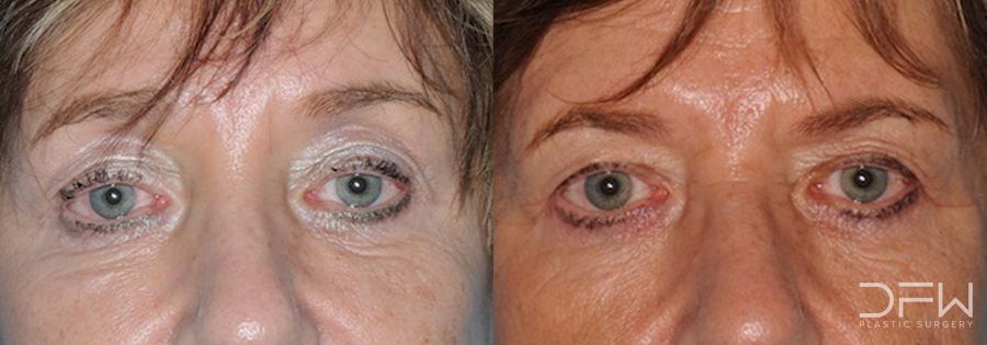 Blepharoplasty - Case 7512