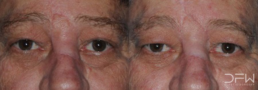 Blepharoplasty - Case 7513