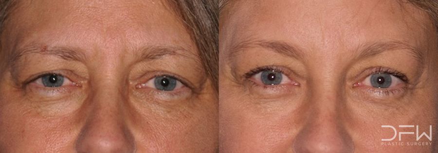 Blepharoplasty - Case 7511