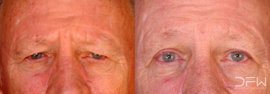 Blepharoplasty - Case 7515
