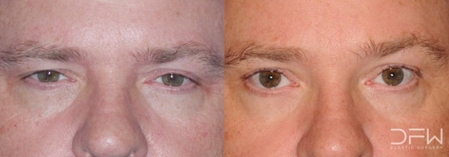 Blepharoplasty - Case 7514