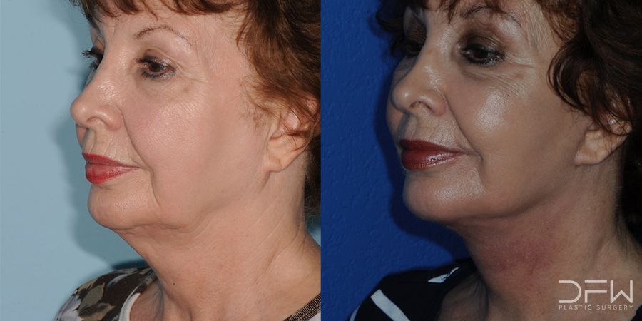 Facelift - Case 7521