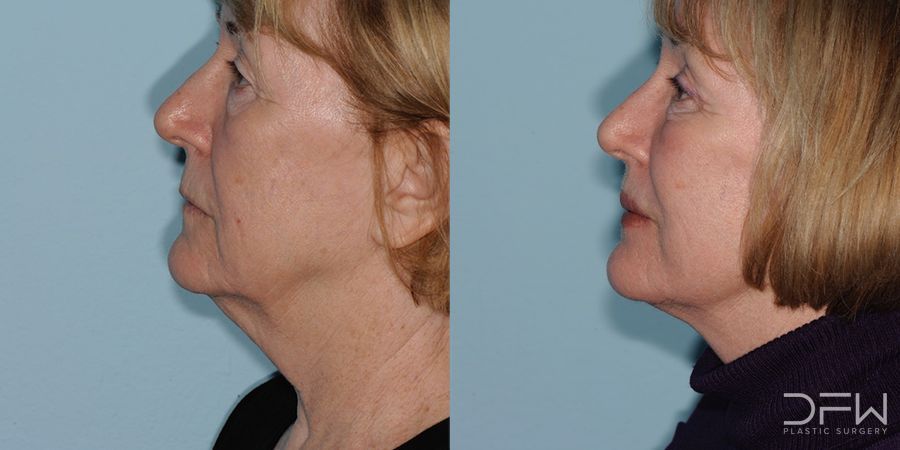 Facelift - Case 7520