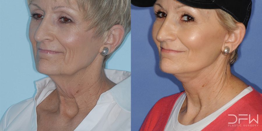 Facelift - Case 7517