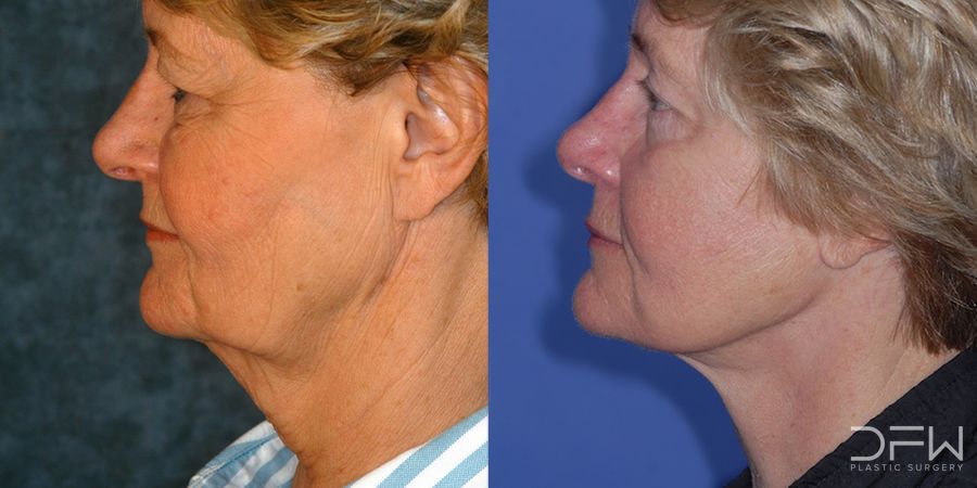 Facelift - Case 7516