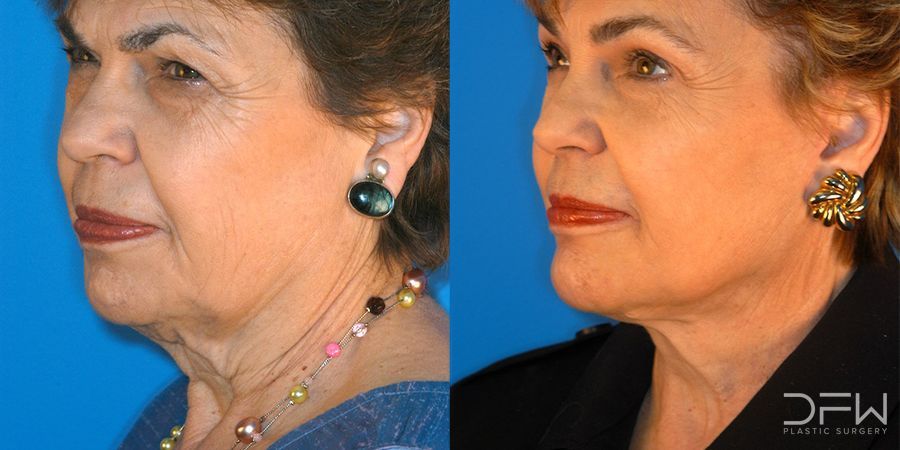 Facelift - Case 7518