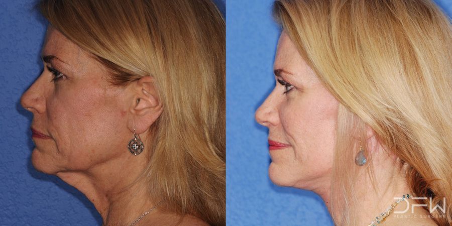 Facelift - Case 7523